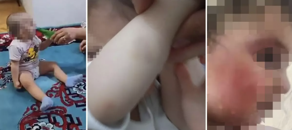 1.5 Yaşındaki Çocuğunu Dövdü Yara İzlerini Fondotenle Gizledi