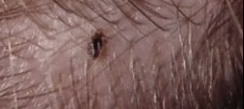 DİKKAT! Gaziantep'te okullarda bit salgını!